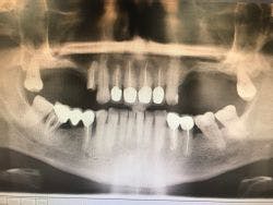 No buccal sulcus after closure of OAC: advice?