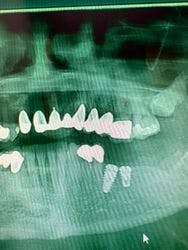 Implants placed too close: Is this restorable?