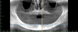 Bar overdenture or implant retained?