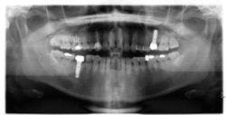Two different implant systems: Identify?
