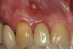 The Management of a Hopeless Maxillary Anterior Tooth: Part I