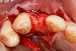 The Management of a Hopeless Maxillary Anterior Tooth Part II: Implant Placement and Restoration