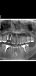 Implant too deep in my lower jaw?