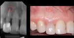 Regenerating Fenestration Defects during Extraction and Implant Placement
