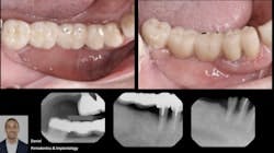 Bone Regeneration of Extensive Socket Defects with Immediate Implant Placement