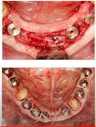 Suturing Tips Around Dental Implants in the Mandible