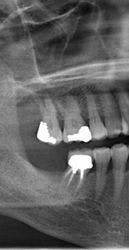 Angled implant or straight implant?