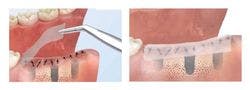Ora-Aid: A new standard in oral wound care?